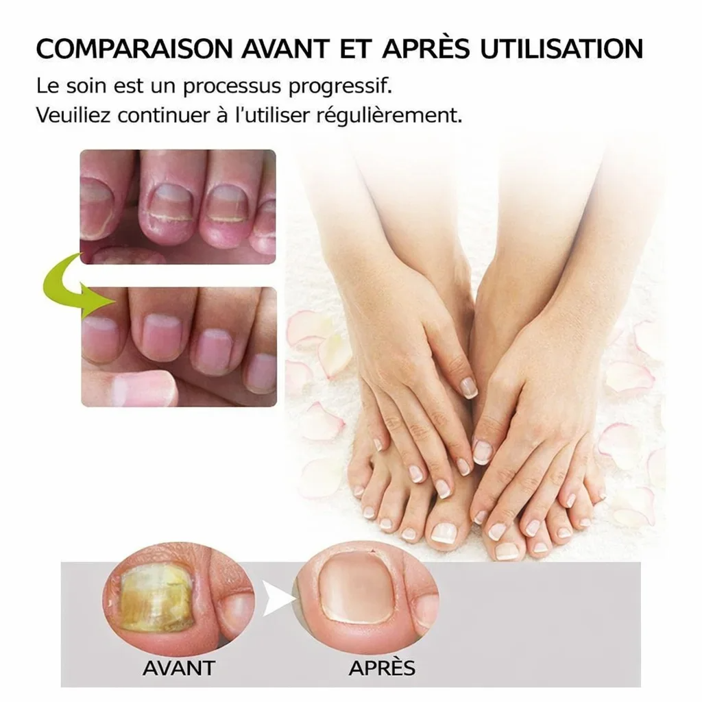 DITES ADIEU AUX ONGLES ABÎMÉS, AUX MYCOSES ET AU PIED D’ATHLÈTE EN SEULEMENT 7 JOURS!
