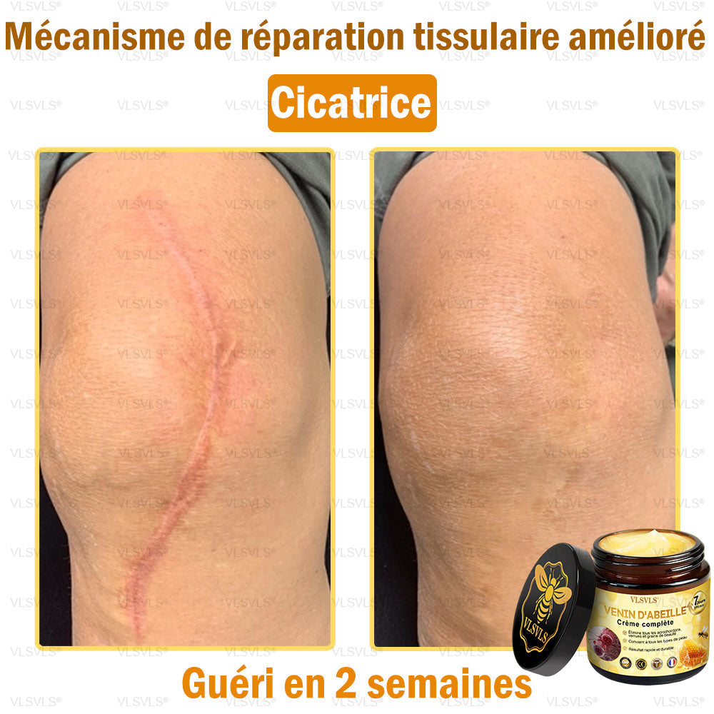 Venin d'abeille Crème de traitement de l'arthrite au venin d'abeille