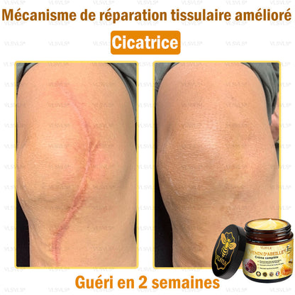 Venin d'abeille Crème de traitement de l'arthrite au venin d'abeille