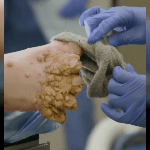 Venin d'abeille Crème de traitement de l'arthrite au venin d'abeille