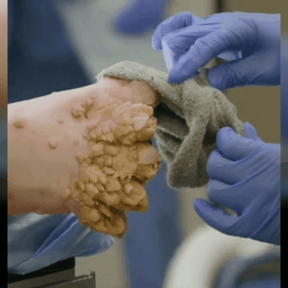 Venin d'abeille Crème de traitement de l'arthrite au venin d'abeille