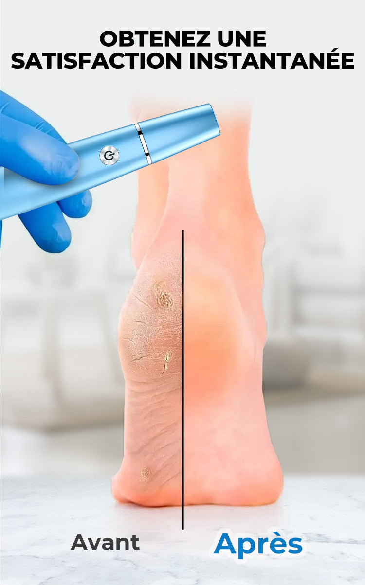 🔥Extracteur de callosités électrique pour les pieds