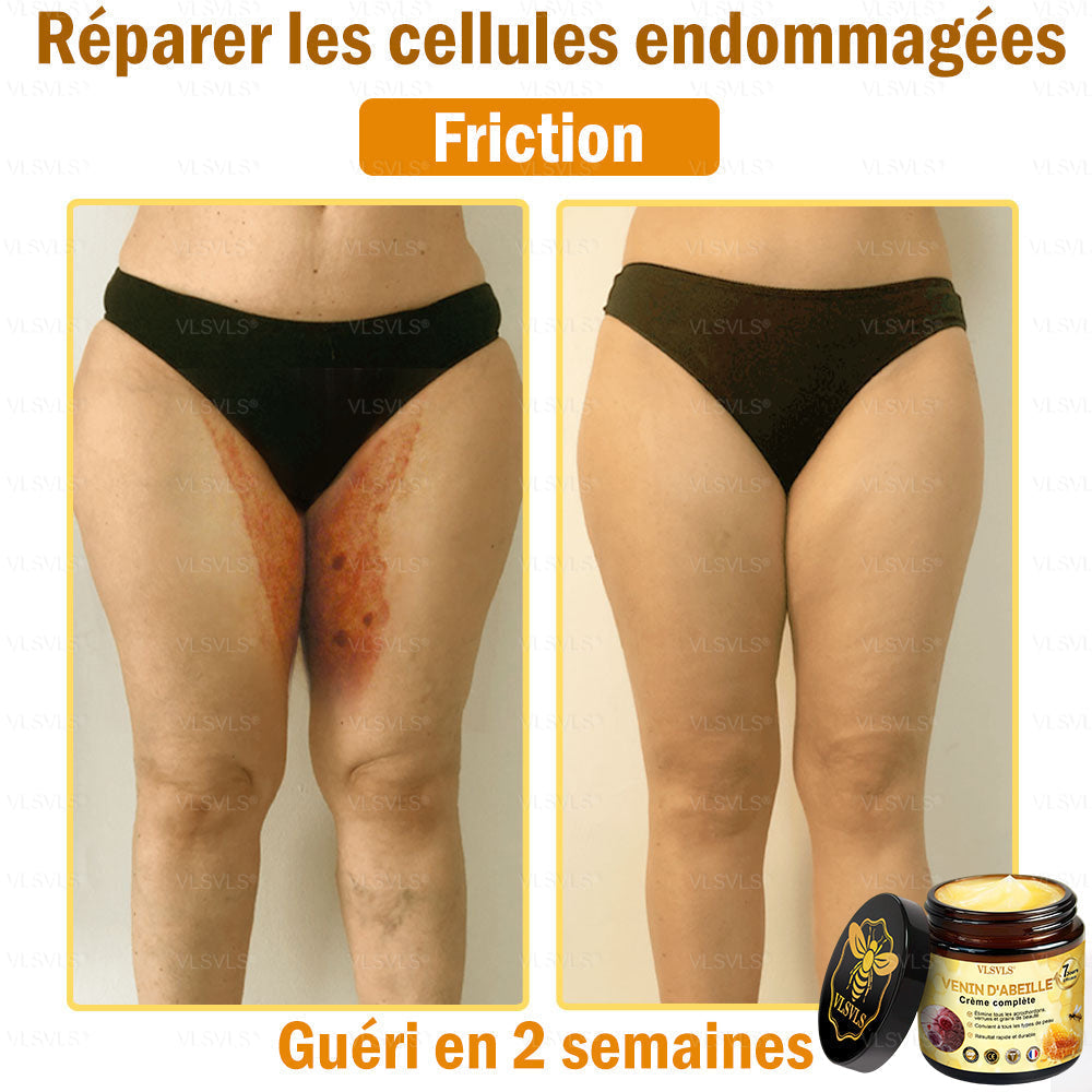 Venin d'abeille Crème de traitement de l'arthrite au venin d'abeille