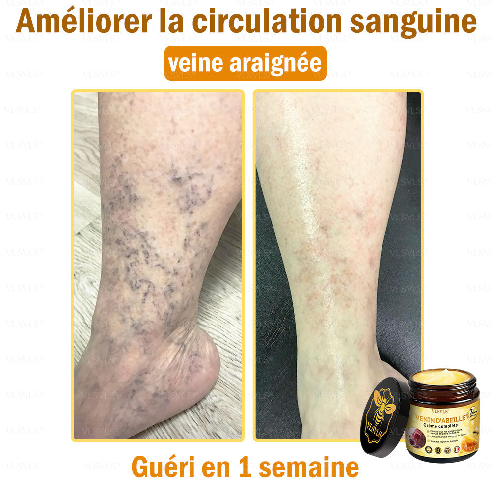 Venin d'abeille Crème de traitement de l'arthrite au venin d'abeille