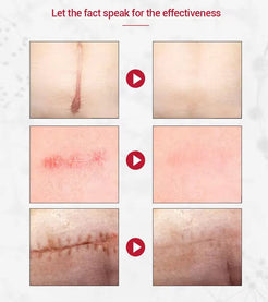Crème Anti Cicatrice