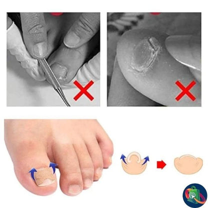 Correcteur d'ongles pour lutter conte les ongles infectés(1 paquet acheté = 1 paquet offert (1 paquet contient 50pièces)