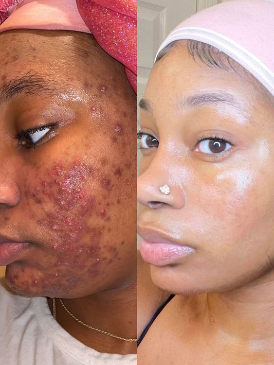 Crème Visage Kojic : Soin Complet Anti-Taches, Acné et Signes de l’Âge