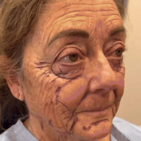 Venin d'abeille Crème de traitement de l'arthrite au venin d'abeille